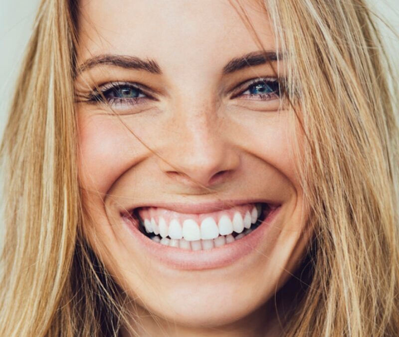 Getting Veneers: How Are They Installed?