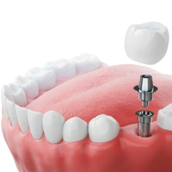 An image of a dental implant getting a crown on it