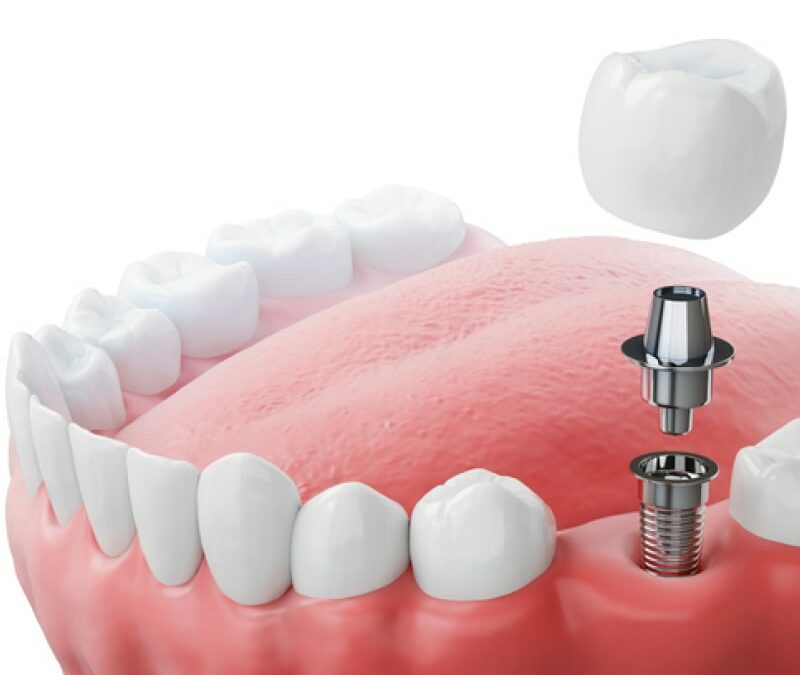 Do You Need a Crown on an Implant? How Long Can You Go Without It?